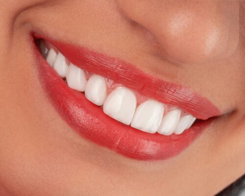 Hollywood smile