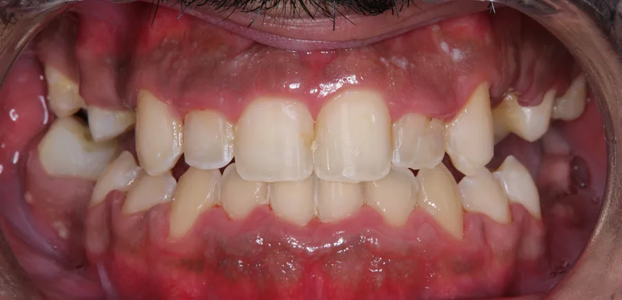 After: Class III · Orthodontic camouflage