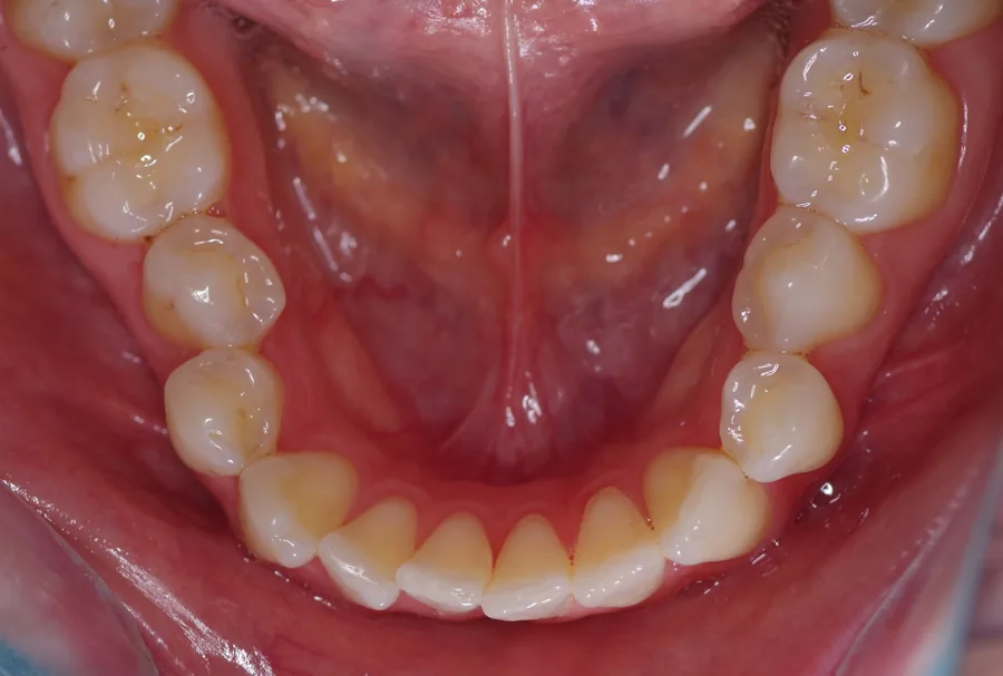 Before: Class I · Spacing and fixed retainers