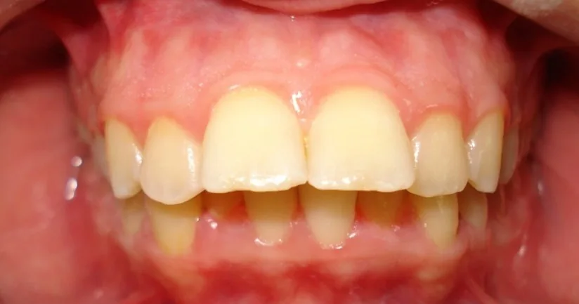 Before: Class II · Distalisation