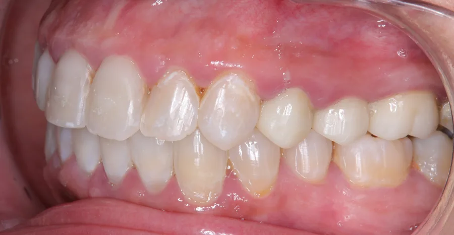 After: Aligners · Spacing and open bite