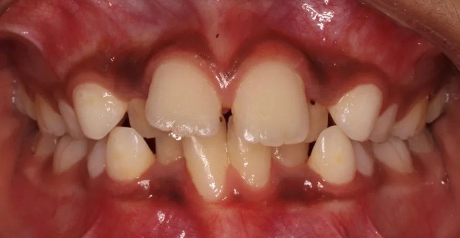Before: Class II · Twin-block followed by braces