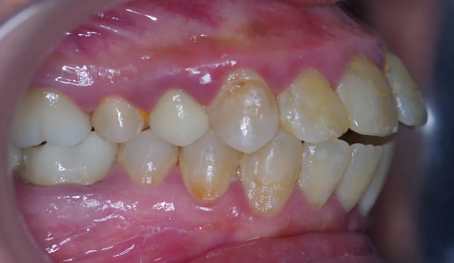 Before: Aligners · Spacing and open bite