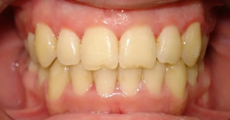 After: Class I · Crowding with extraction