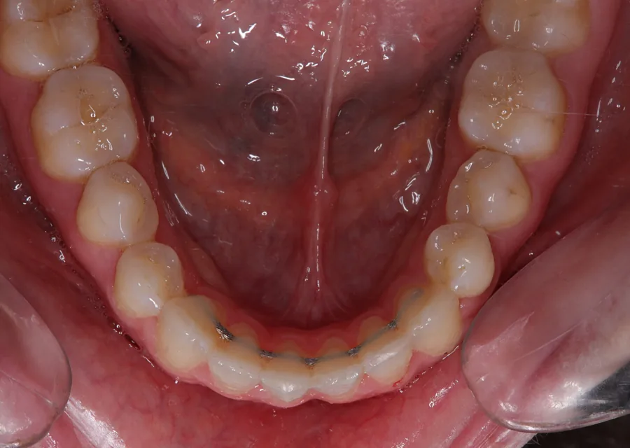 After: Class I · Spacing and fixed retainers