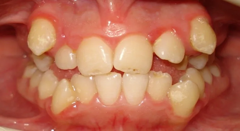 Before: Class I · Crowding with extraction