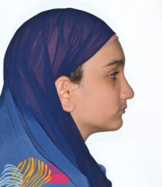 After: Class III · Facemask treatment