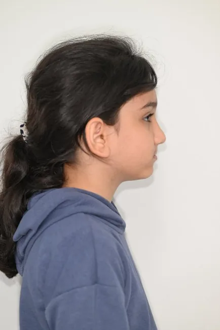 Before: Class III · Facemask treatment
