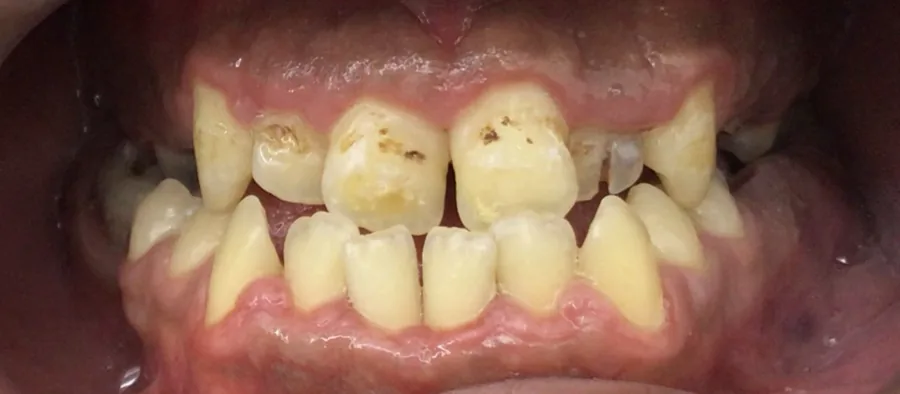 Before: Class III · Orthodontic camouflage