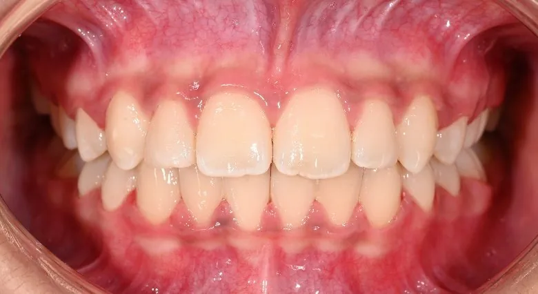 After: Class II · Twin-block followed by braces