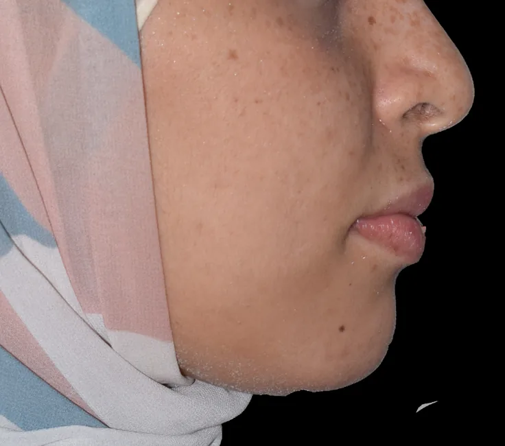 After: Class II · Profile and lip relationship